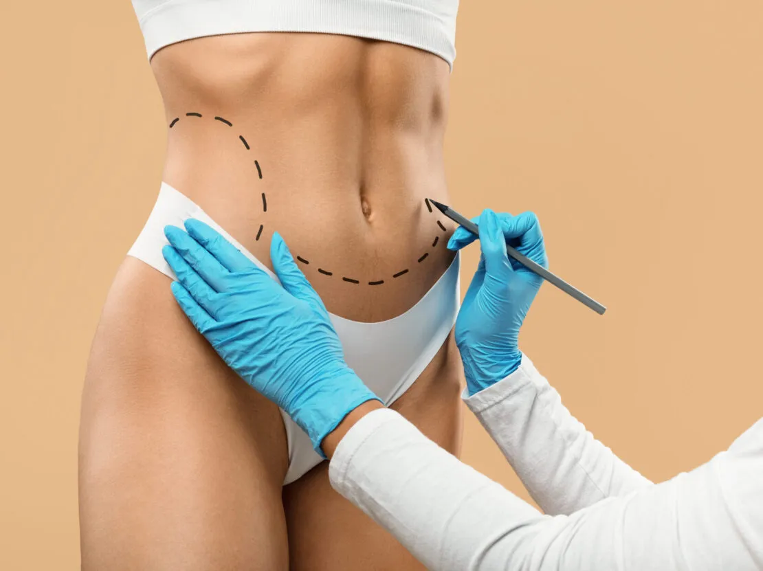 Abdominoplastia