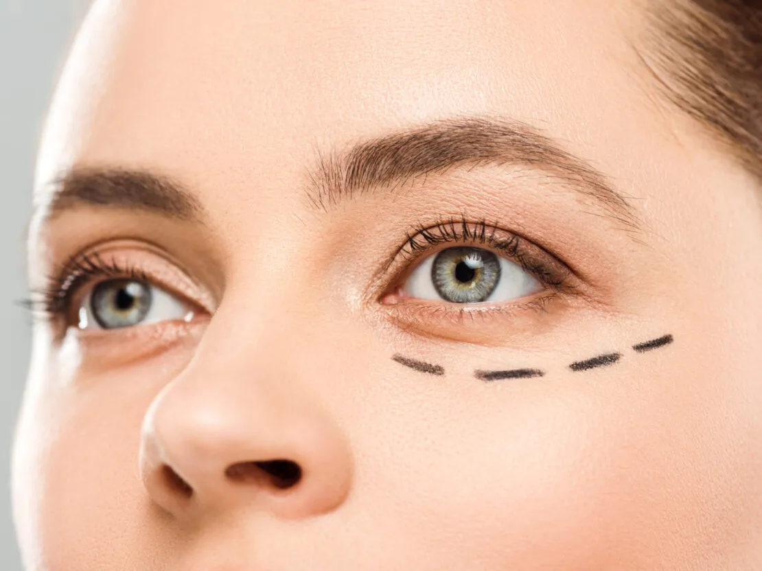Blefaroplastia